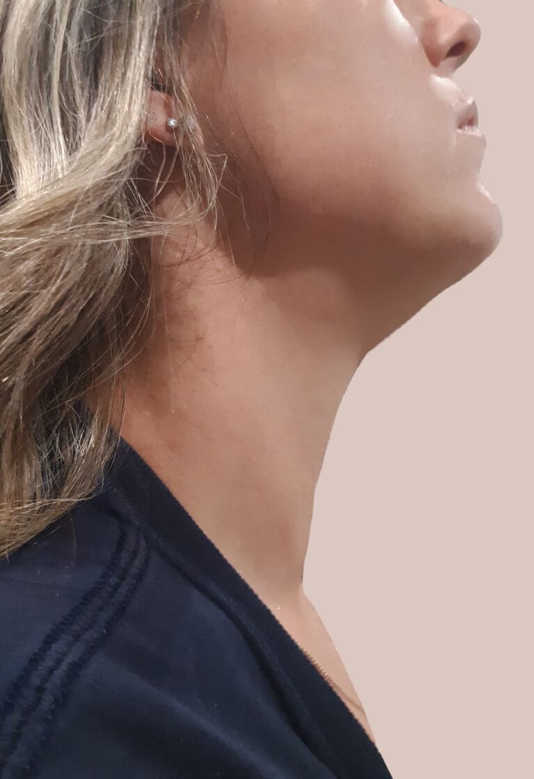6 months after STARMED Thyroid RFA