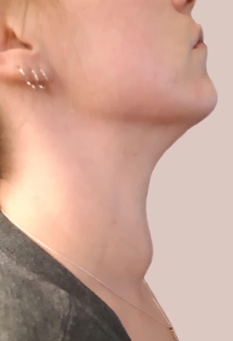 Before STARMED Thyroid RFA