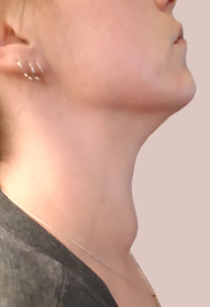 Before STARMED Thyroid RFA
