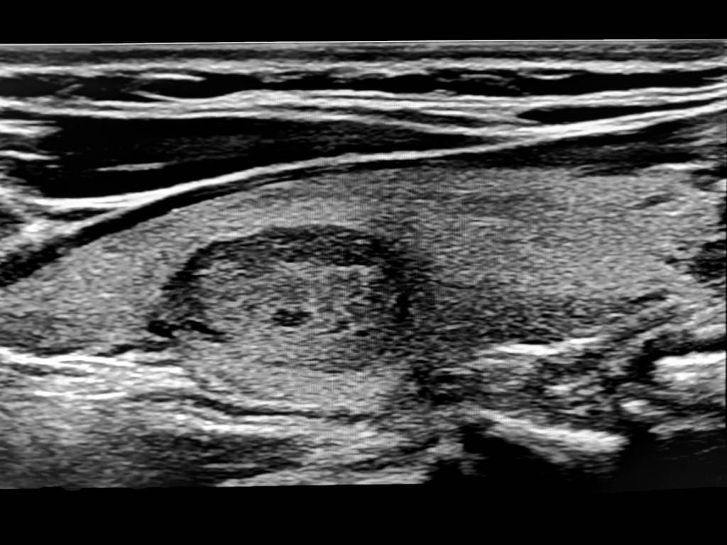 Sonogram image of the human thyroid.