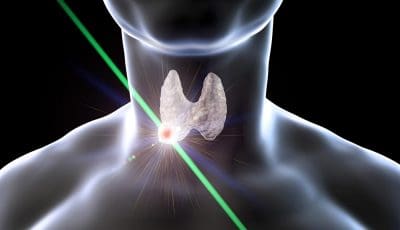 3D rendering of a thyroid nodule being destroyed by ablative energy.
